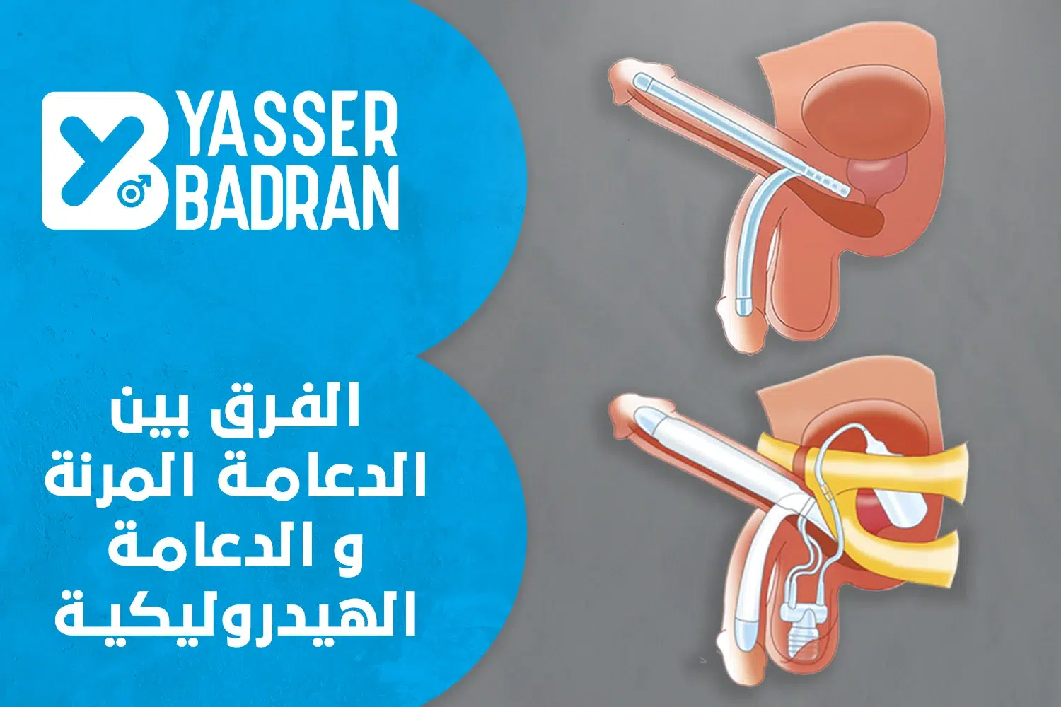 الفرق بين الدعامة المرنة والهيدروليكية بالتفصيل